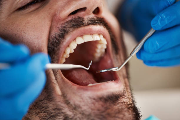 Best Broken or Cracked Tooth Emergency Dentist in Media, PA