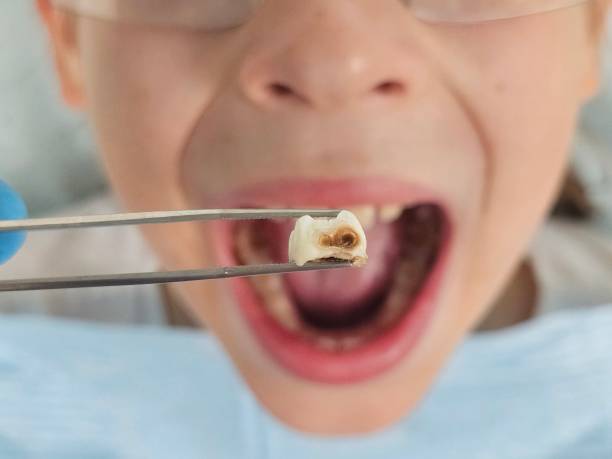 Best Emergency Dental Extractions in Media, PA